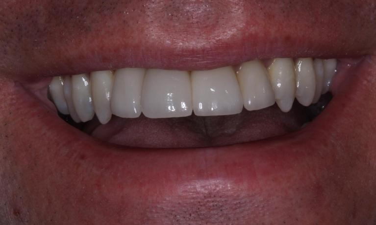 Cosmetic-Implant-Dentistry-After-Image