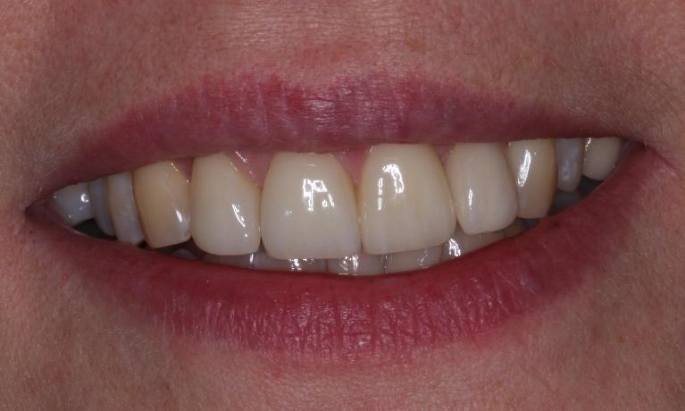Cosmetic-Dentistry-After-Image