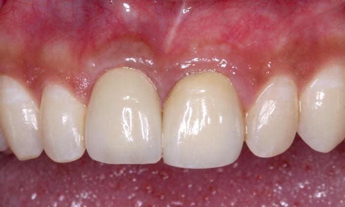 Implant-Crown-After-Image