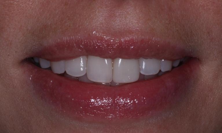Dental Veneers | Trung Pham DMD
