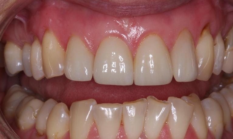 Cosmetic Dentisty Patient | Trung Pham DMD