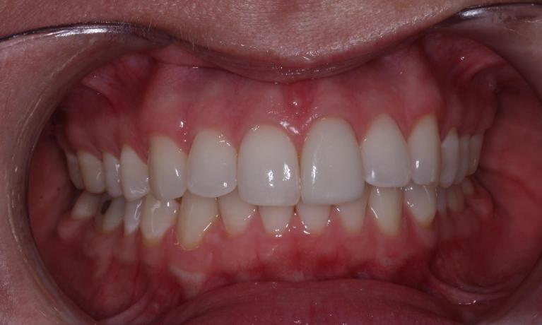 Dental Veneers | Trung Pham DMD