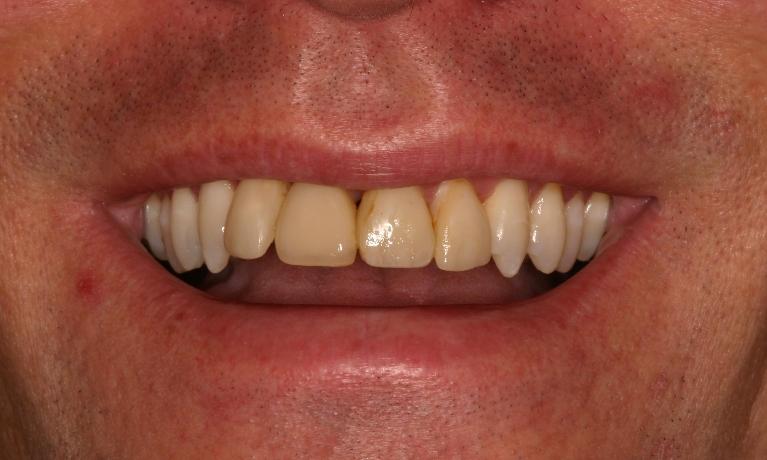 Cosmetic-Implant-Dentistry-Before-Image