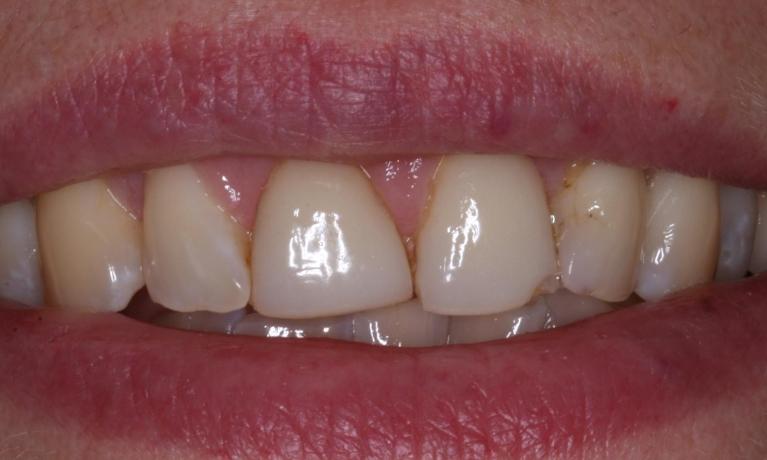 Cosmetic-Dentistry-Before-Image