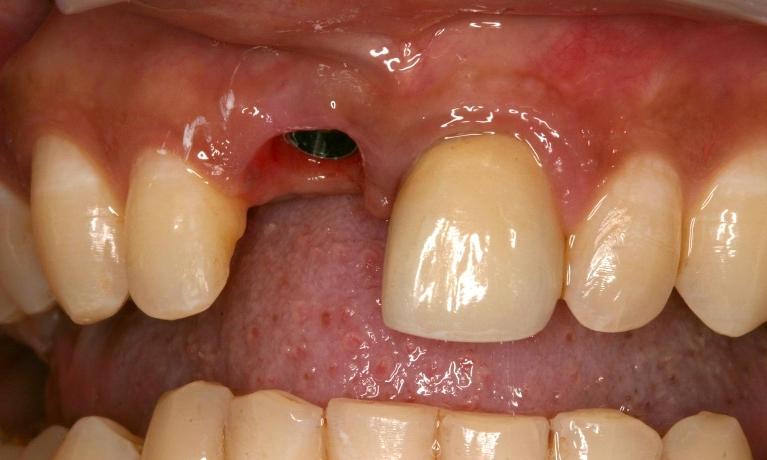 Implant-Crown-Before-Image