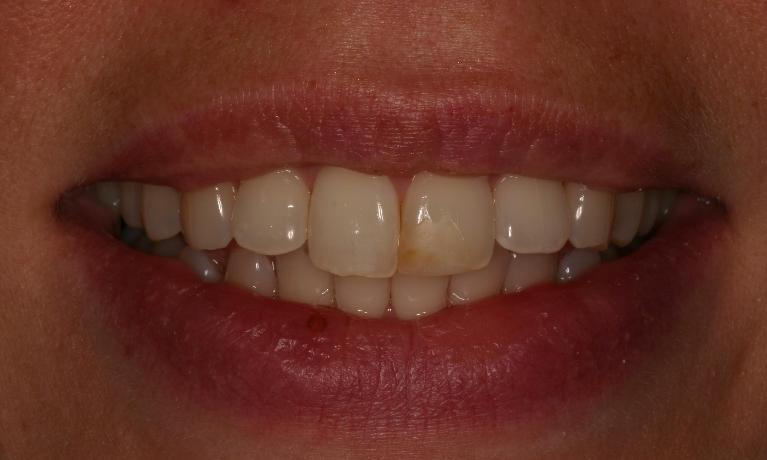 Dental Veneers | Trung Pham DMD