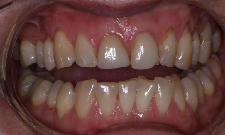 Cosmetic Dentisty Patient | Trung Pham DMD