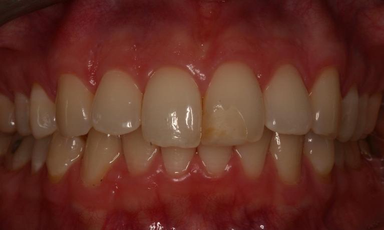 Dental Veneers | Trung Pham DMD